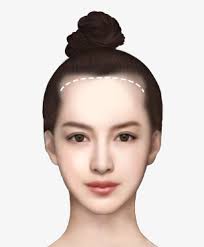 ヘアライン矯正（Hairline Correction）について
